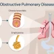 Chronic obstructive pulmonary diseases