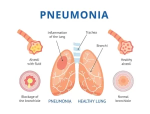 Inflammation of the lung parenchyma