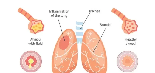 Inflammation of the lung parenchyma