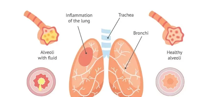 Inflammation of the lung parenchyma