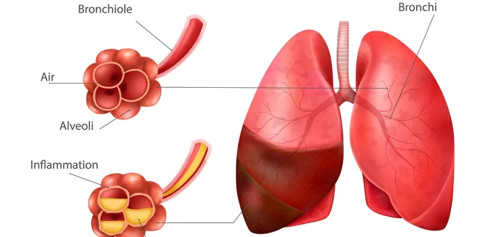 Pneumonia