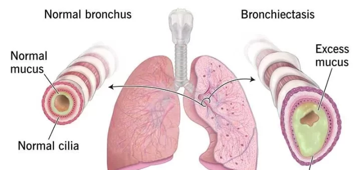 Bronchiectasis