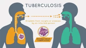 Tuberculosis 