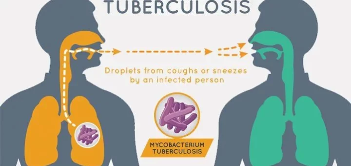 Tuberculosis