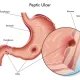 Peptic ulcer