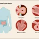 Abdominal obstruction types